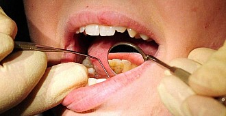 Dişeti hastalarının bunama oranı yüksek